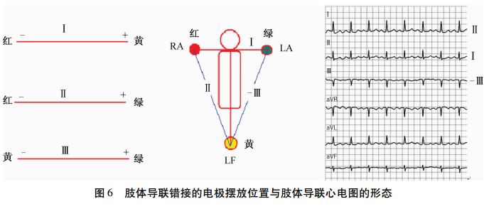 图解肢体导联电极错接的心电图表现