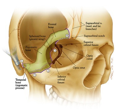 从眶上切迹外侧开始,向后向外切割眶顶,至眶上裂外侧缘,继续向后向外
