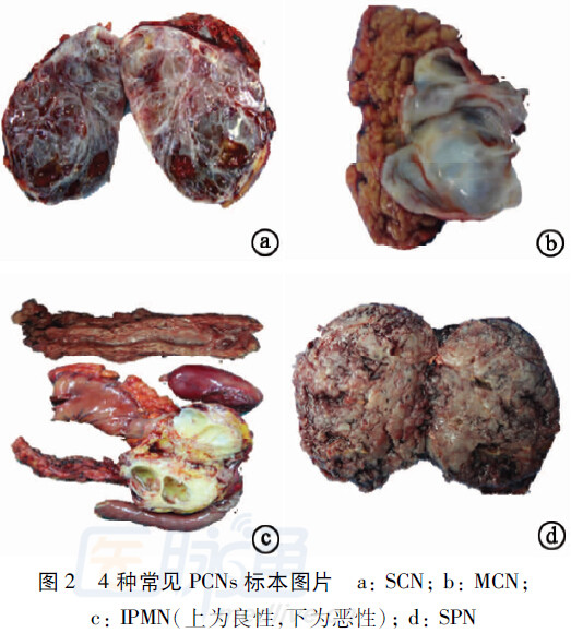 囊腺癌 mip.haodf.com