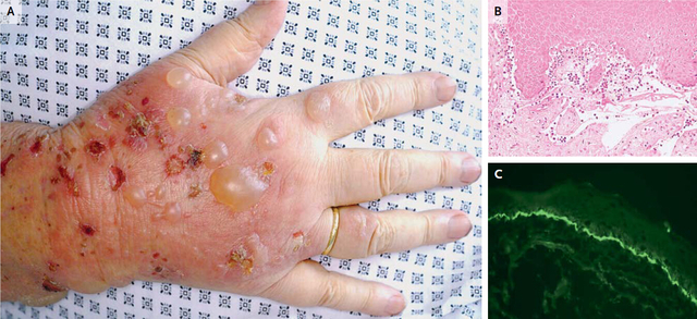 nejm临床图片大疱性类天疱疮