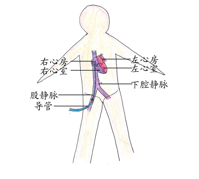 图说房颤导管射频消融术