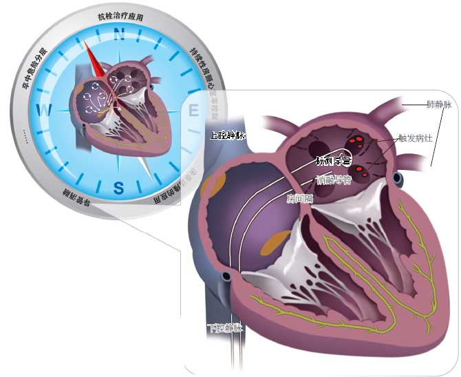 医学动画：带你了解房颤