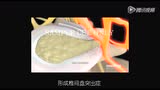 医学动画：带你了解腰椎间盘突出