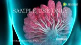 医学动画：Breast Biopsy（乳房活检）