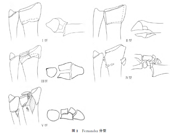 基於損傷機制的骨折分型對骨折臨床診治的指導意義