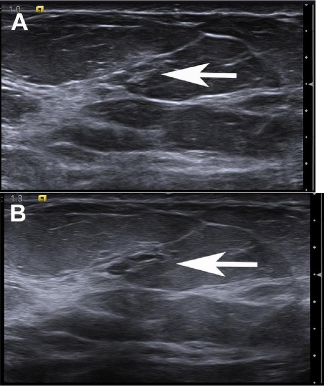 正常乳腺超声图像图片