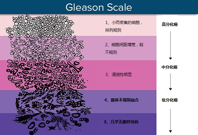 如图7所示,根据前列腺腺体分化程度按照5级评分,分数由低到高为分化