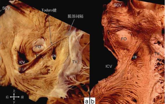 房室交界区之koch三角