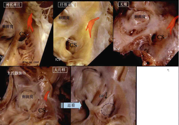 三尖瓣隔瓣:三尖瓣分為前瓣,後瓣和隔瓣,組成koch三角的即為隔瓣.